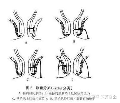 肛瘘最新治疗论述