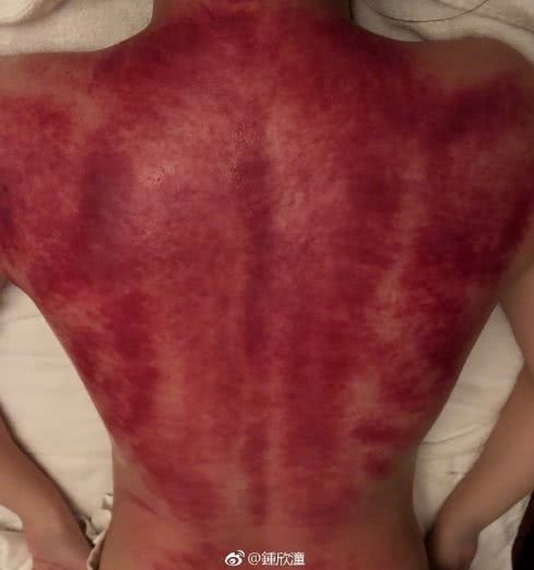 最新滴痧操作指南，一步步教你完成这项任务